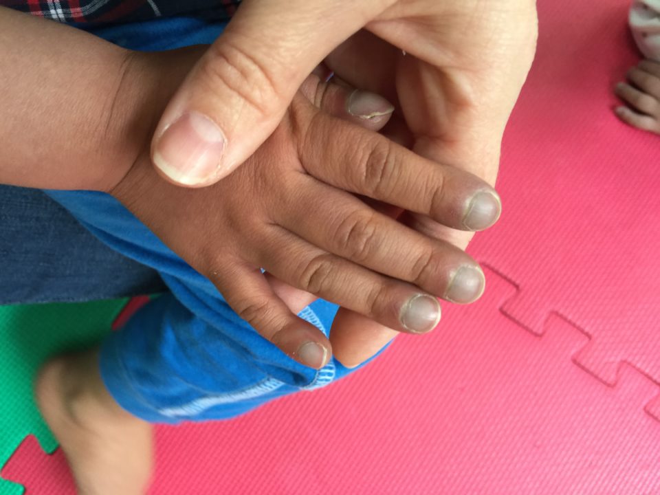 Andrea holds the hand of a child who has complex congenital heart disease to illustrate his cyanosis and clubbing.