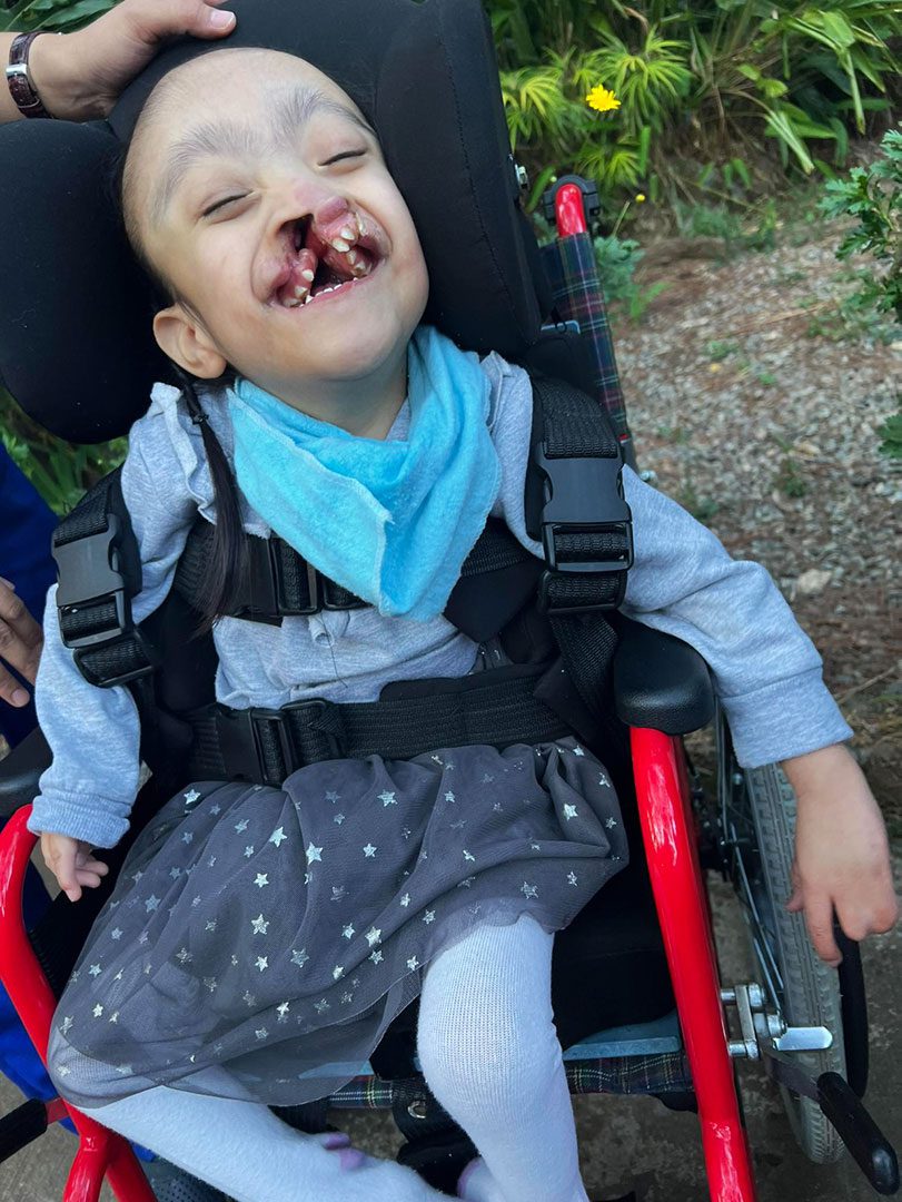 A girl with a cleft lip and palate smiles in a wheelchair